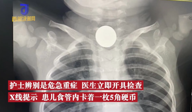2岁娃咳嗽50天查出硬币卡喉 网友:这家长心真大-第2张图片-9158手机教程网 2岁娃咳嗽50天查出硬币卡喉 网友:这家长心真大-第2张图片-9158手机教程网